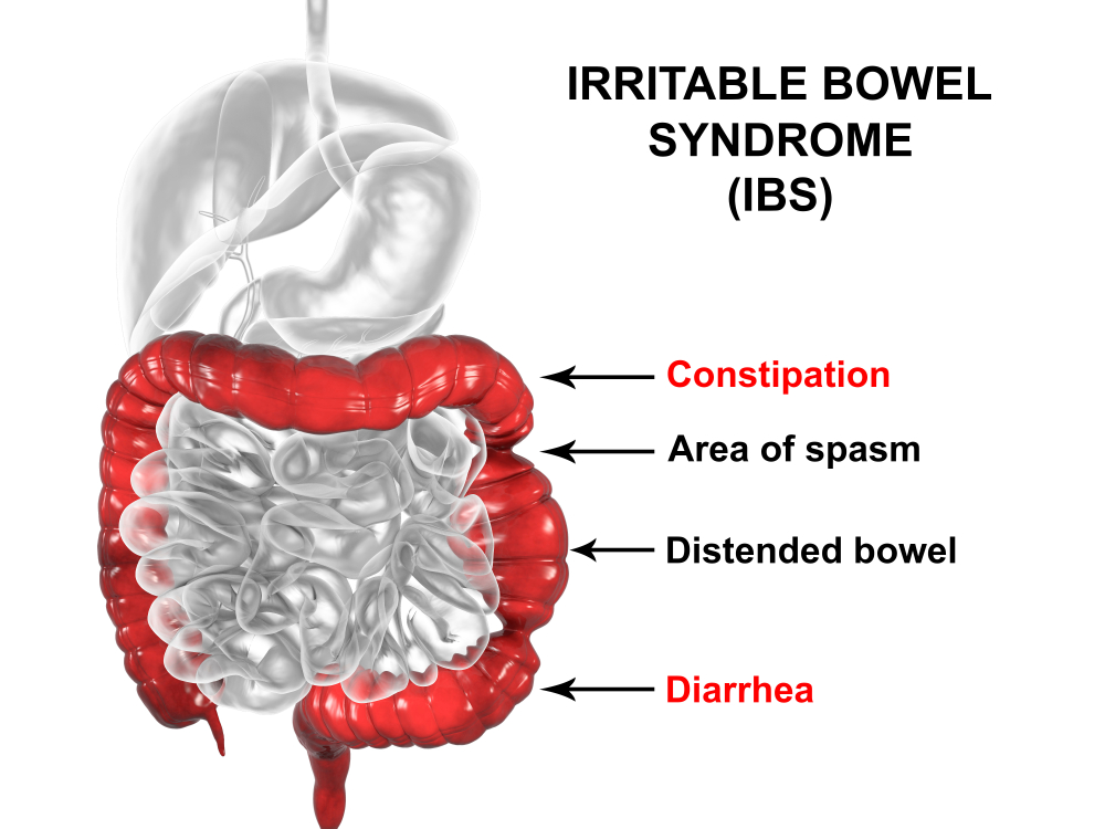 IBS_Syndrome